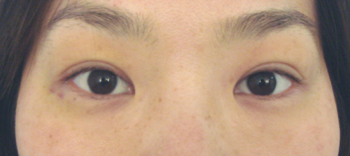 術后一周,腫脹基本消失。