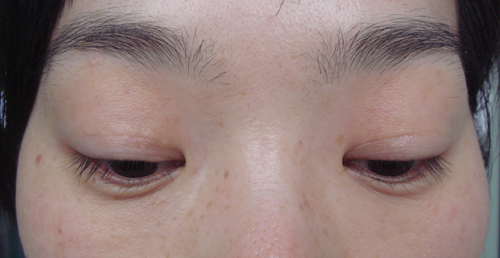 術后1年,顯示手術位置無明顯疤痕,重瞼接近自然狀態。