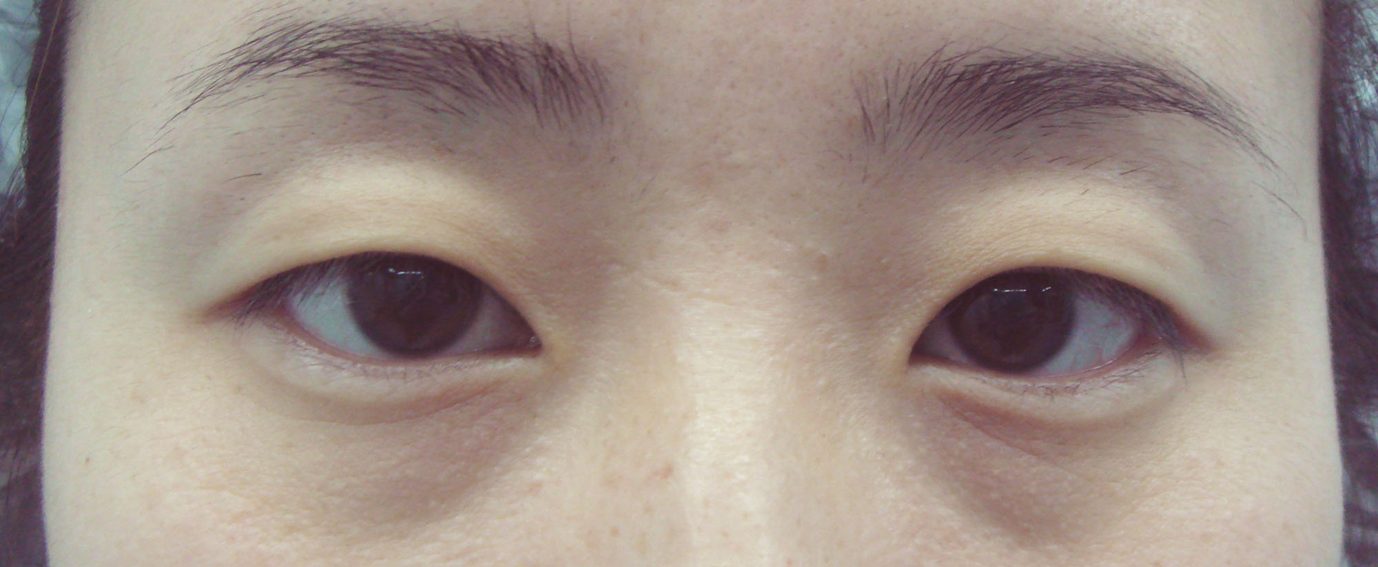 術前雙眼單瞼。