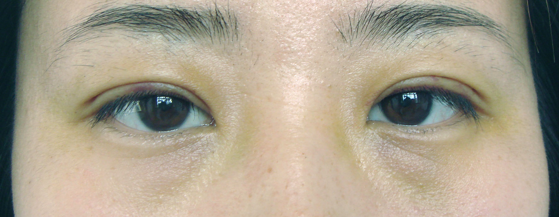 術后1周,雙眼明顯增大有神,重瞼弧度自然、對稱。