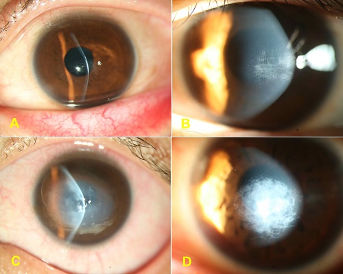圖1：A，大曲率的完成期圓錐角膜；B，vogt線陽性；C，圓錐角膜急性水腫期；D，圓錐角膜瘢痕期