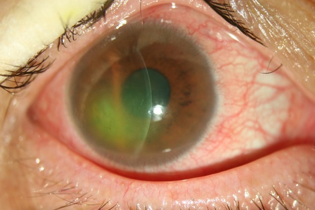 熒光素染色顯示著色區(綠色)為角膜上皮糜爛